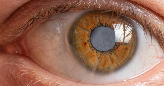 Cataracts and Their Treatment Options