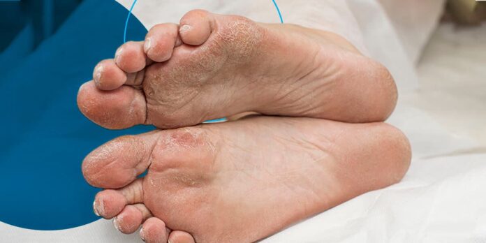 Diabetes Affect Feet