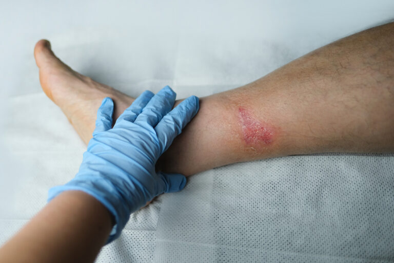 Wound Isn't Healing Properly