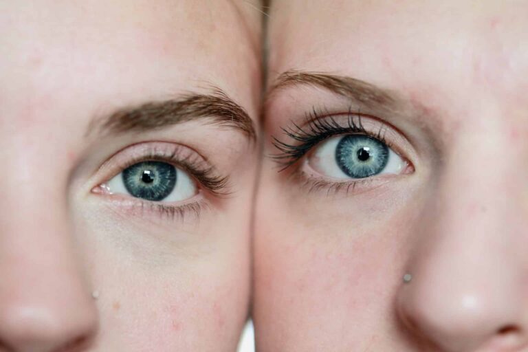 Brow Lift